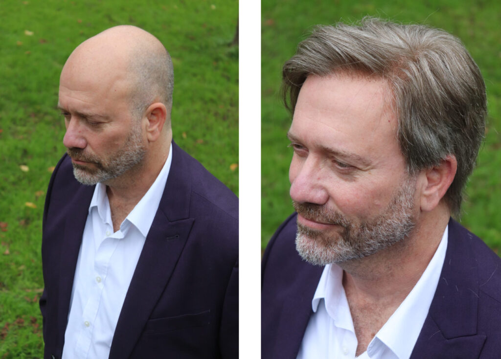 Geheel haarwerk voor kaalheid bij man
